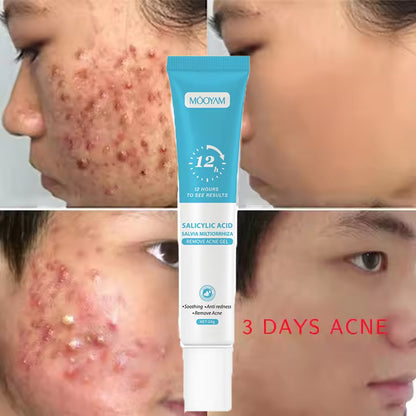 Salicylic Acid Acne Repair Gel – Anti-Spot &amp; Blemish Care Cream